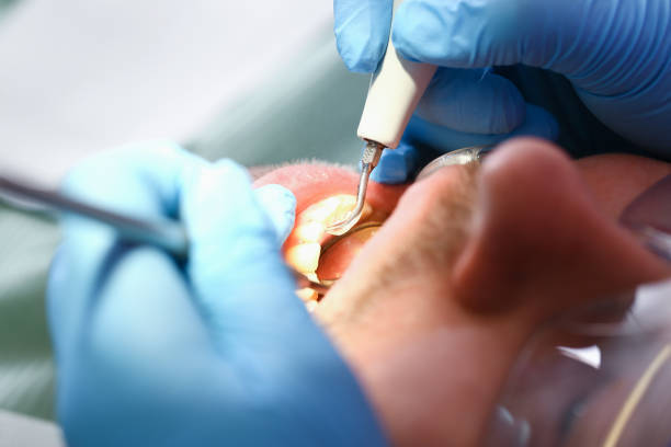 Best Emergency Tooth Extraction in Sycamore, GA