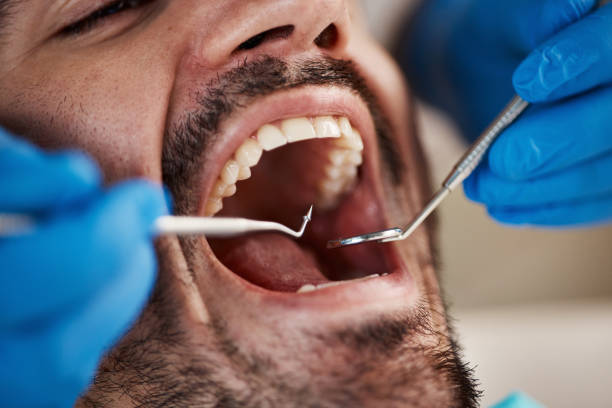 Best Emergency Wisdom Teeth Removal in Sycamore, GA